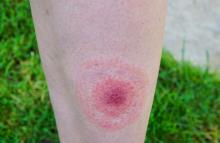 Ham Wonderbaarlijk hop Diagnostiek: Erythema Migrans (rode vlek of ring) | Nederlands Lymeziekte-expertisecentrum Ham Wonderbaarlijk hop Diagnostiek: Erythema Migrans (rode vlek of ring) | Nederlands Lymeziekte-expertisecentrum
